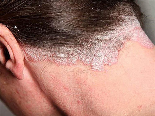 Hình ảnh bệnh vẩy nến da đầu